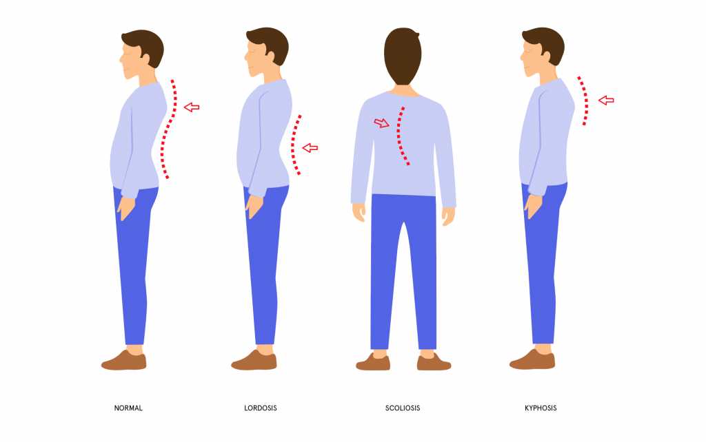 Боли в спине нарушение осанки. Типы осанки по штаффелю. Лордоз кифоз сколиоз. Лордоз схема.