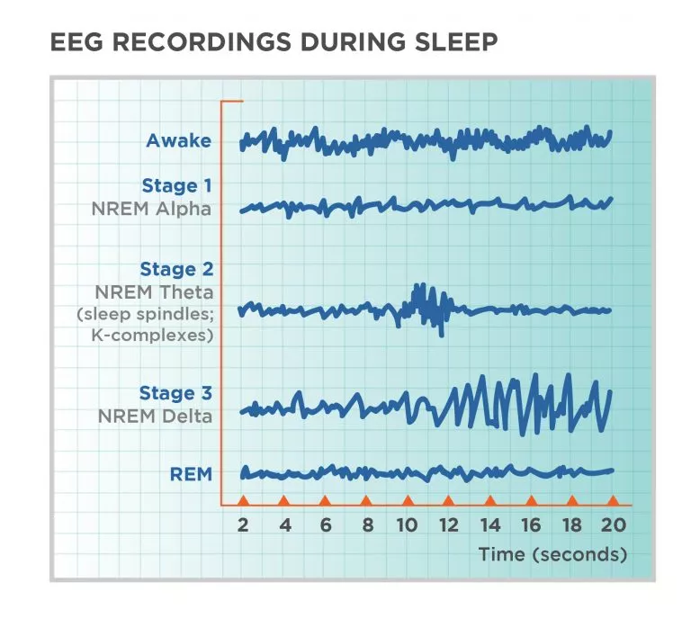 fitbit sleep apnea pattern